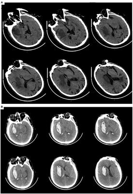 Case Report: Visual Deprivation in Pusher Syndrome Complicated by Hemispatial Neglect After Basal Ganglia Stroke